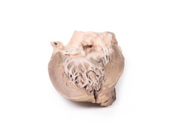 Acute Bacteriële Endocarditis, 3D Print