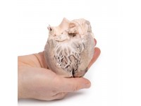 Acute Bacteriële Endocarditis, 3D Print