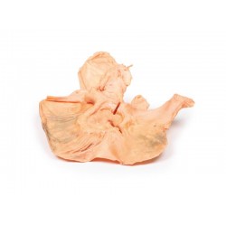 Adenomacarcinoom in de Maag, 3D Print Adenomacarcinoom in de Maag, 3D Print