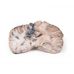 Arterioveneuze Malformatie in de Hersenen, 3D Print Arterioveneuze Malformatie in de Hersenen, 3D Print