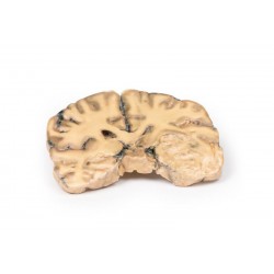 Astrocytoom, 3D Print