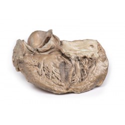 Bicuspide Aortaklep, 3D Print