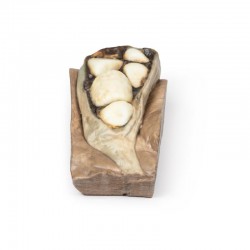 Cholelithiasis (Galstenen), 3D Print