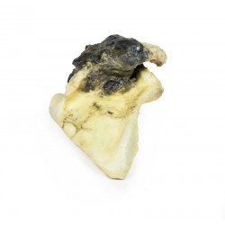 Chondrosarcoom in Schouderblad, 3D Print