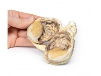 Chronische Hydrocele, 3D Print