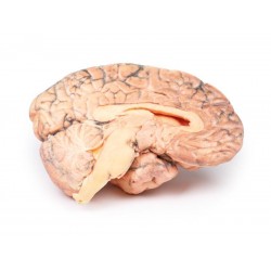 Craniofaryngioom, 3D Print