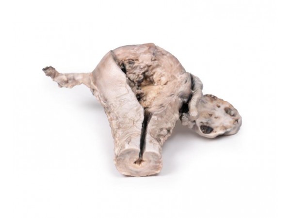 Endometriumcarcinoom, 3D Print