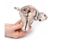 Endometriumcarcinoom, 3D Print