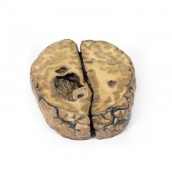 Gemetastaseerd Carsinoom in de Hersenen, 3D Print