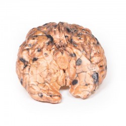 Gemetastaseerd Melanoom, 3D Print