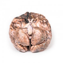 Gescheurd Sacculair Aneurysma, 3D Print