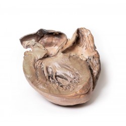 Gescheurd Thoracaal Aorta Aneurysma, 3D Print Gescheurd Thoracaal Aorta Aneurysma, 3D Print