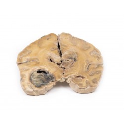 Glioblastoma Multiforme, 3D Print