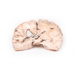 Herseninfarct Links, 3D Print