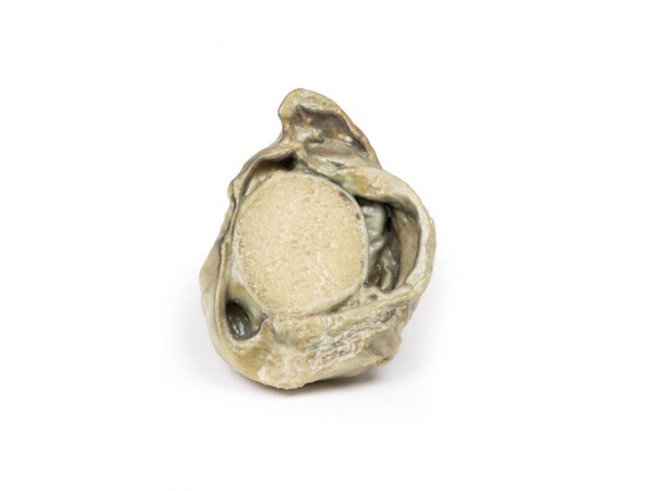 Hydrocele, 3D Print