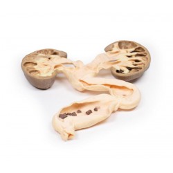 Hydronefrose en Hydro-ureter, 3D Print