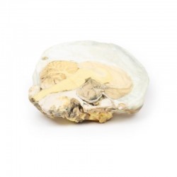 Hypofyse Adenoom, 3D Print