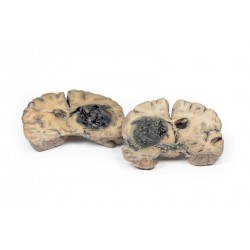 Intracerebrale Bloeding, 3D Print