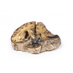 Intracraniële Ruimte Innemende Laesie, 3D Print