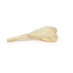 Osteosarcoom in Dijbeen, 3D Print