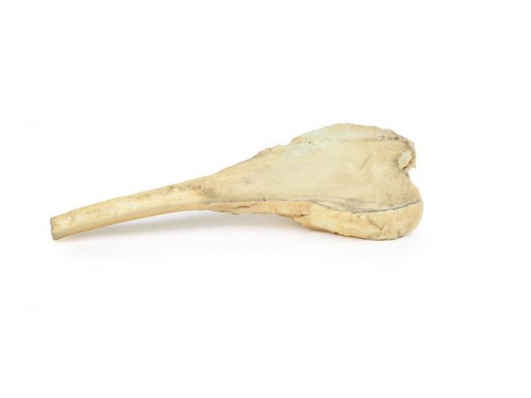 Osteosarcoom in Dijbeen, 3D Print