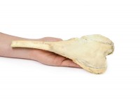 Osteosarcoom in Dijbeen, 3D Print