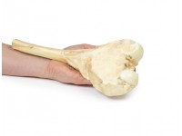 Osteosarcoom in Dijbeen, 3D Print