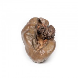 Papillair Overgangscelcarcinoom in het Nierbekken, 3D Print