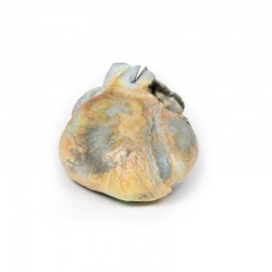 Rechterventrikelhypertrofie, 3D Print Rechterventrikelhypertrofie, 3D Print