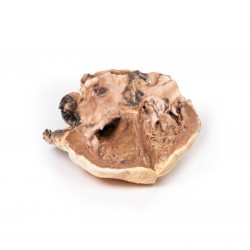 Reumatische Endocarditis, 3D Print