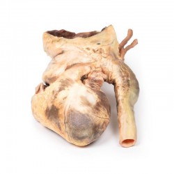 Syfilitisch Aneurysma, 3D Print Syfilitisch Aneurysma, 3D Print