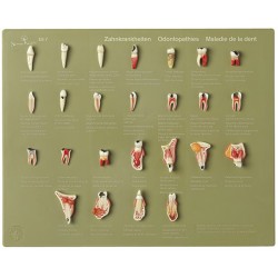 Anatomisch model tandheelkundige aandoeningen