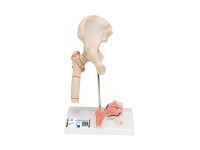 Dijbeenbreuk en hiposteoarthritis