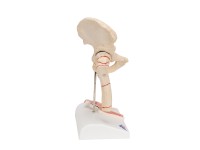 Dijbeenbreuk en hiposteoarthritis
