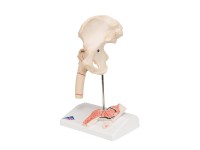 Dijbeenbreuk en hiposteoarthritis