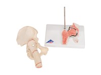 Dijbeenbreuk en hiposteoarthritis