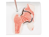 Dijbeenbreuk en hiposteoarthritis