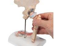 Dijbeenbreuk en hiposteoarthritis