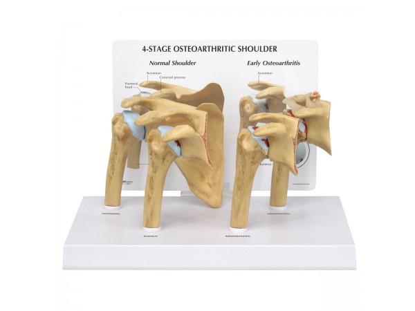 Schoudergewricht met Artrose, 4-delig
