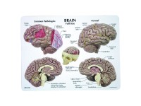Hersenmodel met ziektebeelden in schedelhelft