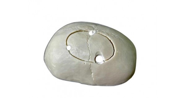Calvarium Model met Schedeltrepanatie