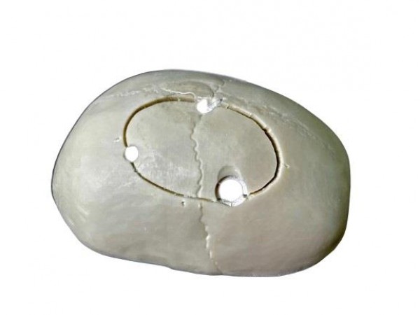 Calvarium Model met Schedeltrepanatie