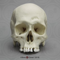 Schedelmodel met Hamerinslag Schedelmodel met Hamerinslag