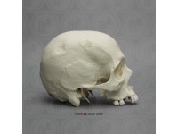 Schedelmodel met Hamerinslag