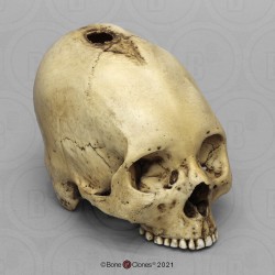 Schedelmodel Trepanatie Schedelmodel Trepanatie