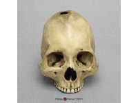 Schedelmodel Trepanatie