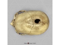 Schedelmodel Trepanatie