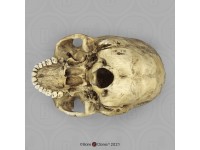 Schedelmodel Trepanatie