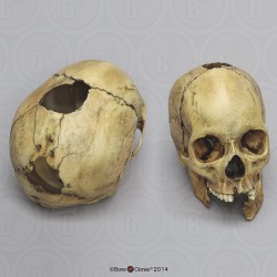 Vrouwelijk Schedelmodel met Schotwonden Vrouwelijk Schedelmodel met Schotwonden