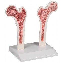 Doorsnede Dijbeen met Osteoporose